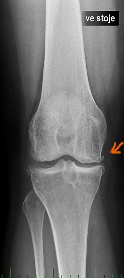 Artróza - RTG kolen ve stoje v předozadní projekci, se snížením kloubní štěrbiny na vnitřní straně, většinou po předchozím odstranění poraněného menisku (v řádu 10 a více let), 1