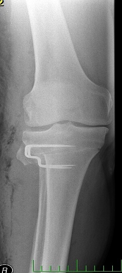 Artróza - RTG stavu po změně osy z postižené strany na zdravou pomocí valgizační osteotomie closed-wedge