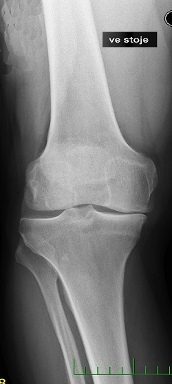 Artróza - RTG kolen ve stoje v předozadní projekci, se snížením kloubní štěrbiny na vnitřní straně, většinou po předchozím odstranění poraněného menisku (v řádu 10 a více let), 3